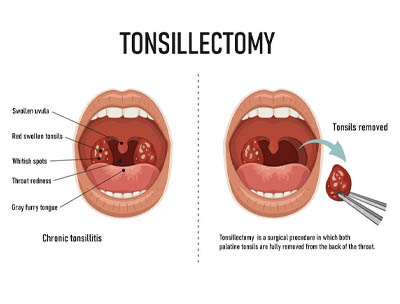 Tonsillectomy Treatment Kota