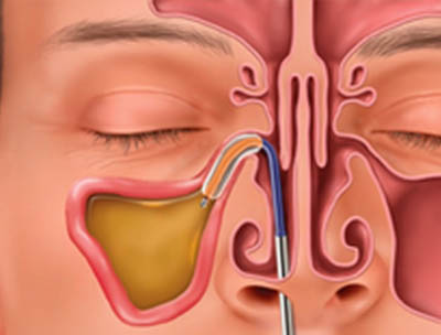 Balloon Sinuplasty Techniques