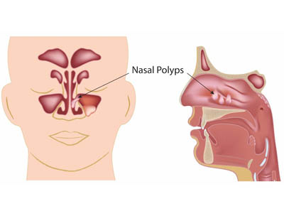 Nasal Polypectomy Hospital Kota