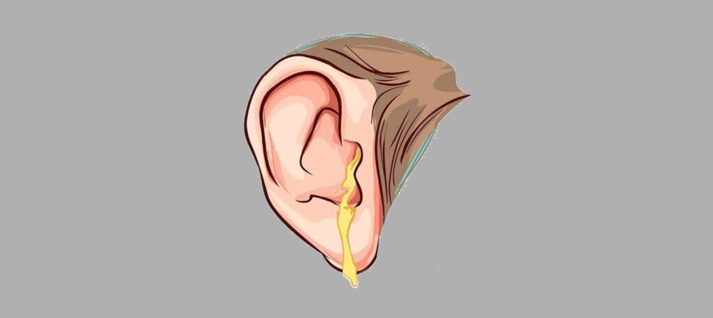 Ear Infections & Types