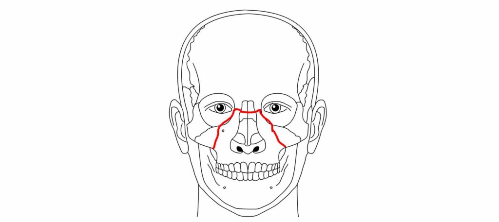 Facial Fractures