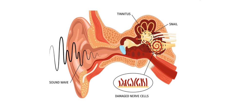Inner Ear Infection